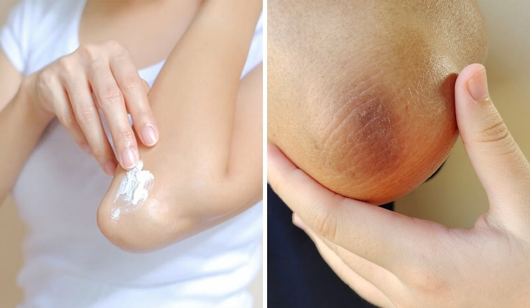 Cách trị thâm khuỷu tay hiệu quả tại nhà, da sáng mịn chỉ sau vài tuần