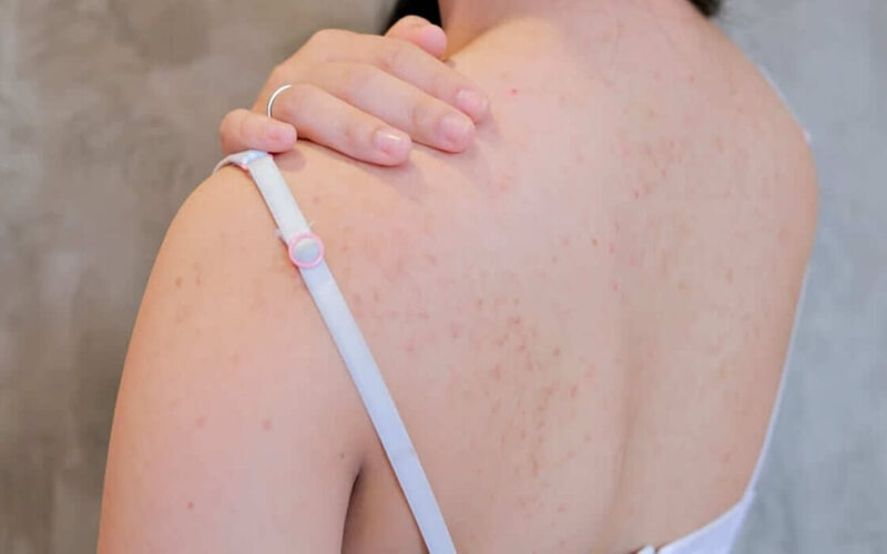 Cách phòng ngừa mụn lưng