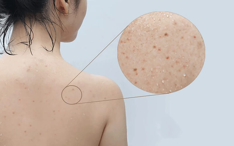 Các loại mụn thường gặp trên lưng