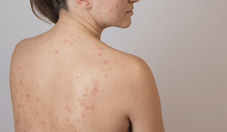 Mụn lưng do đâu? Nguyên nhân và cách trị mụn lưng