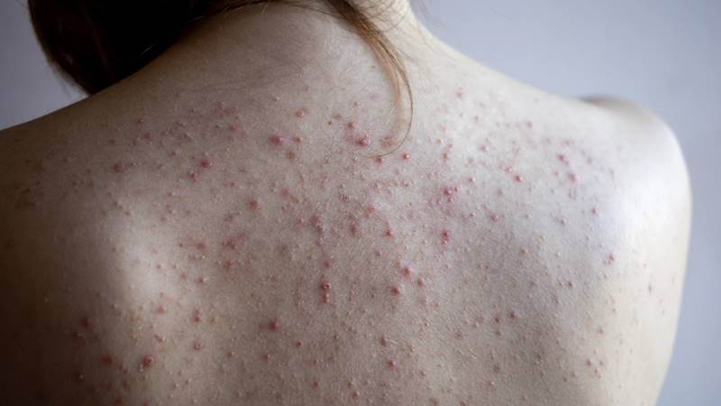 Mụn lưng trên da lưng