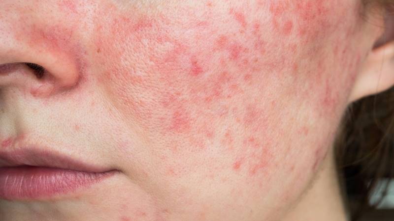 Da bị dị ứng mỹ phẩm 