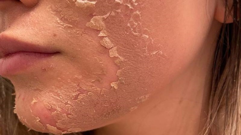 Các hoạt chất dùng trong peel da Các hoạt chất dùng trong peel da