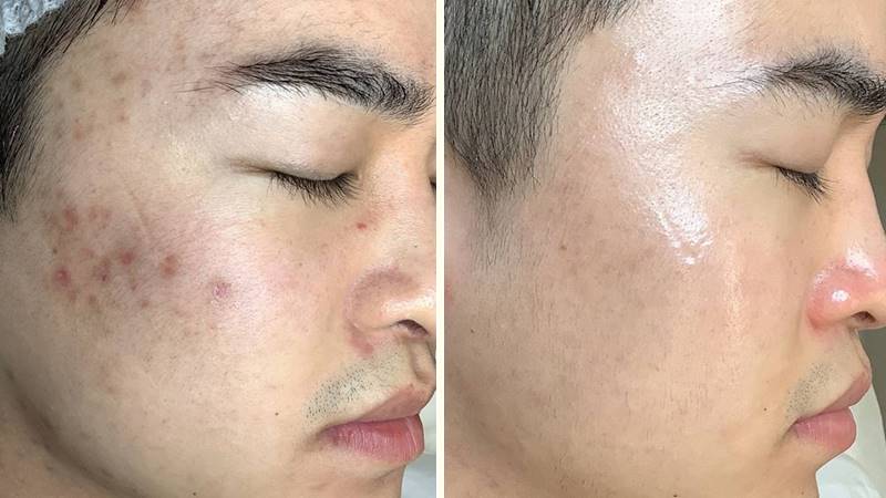 Peel da mang lại nhiều lợi ích Peel da mang lại nhiều lợi ích