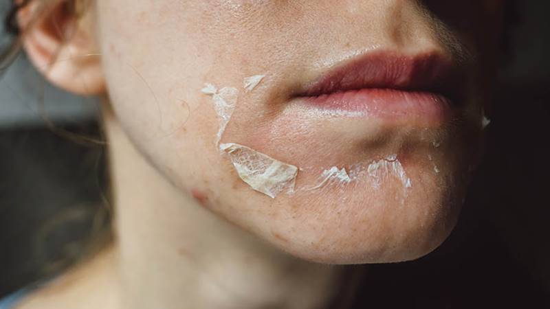 Cách peel da an toàn, hiệu quả Cách peel da an toàn, hiệu quả