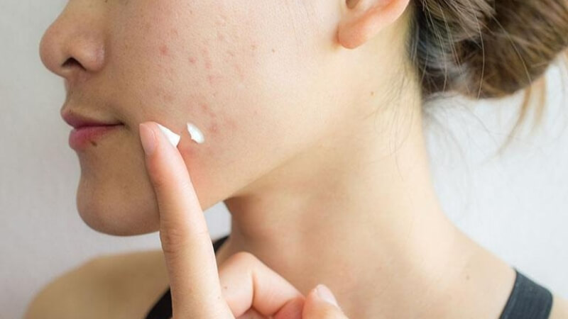 Có thể thêm các sản phẩm đặc trị (treatment) vào chu trình tối giản Có thể thêm các sản phẩm đặc trị (treatment) vào chu trình tối giản
