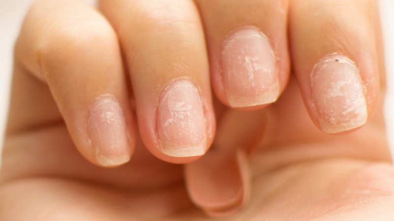 Móng tay bị sần sùi là thiếu chất gì?