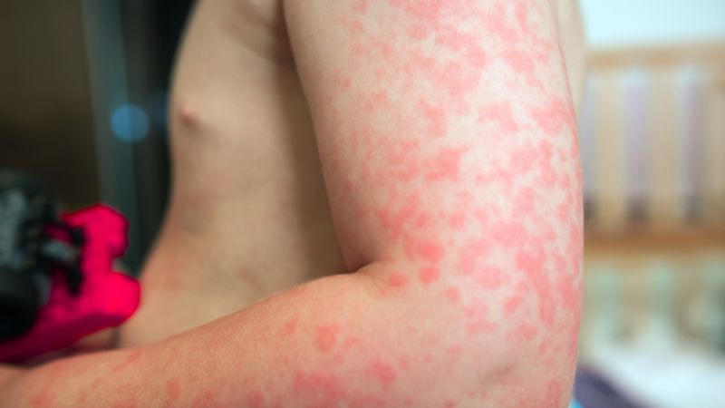 Những bệnh thường gặp sau mưa lũ
