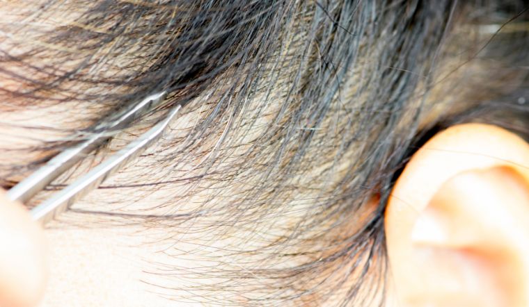 Tóc bạc nhiều nhổ có làm giảm số lượng tóc bạc không?