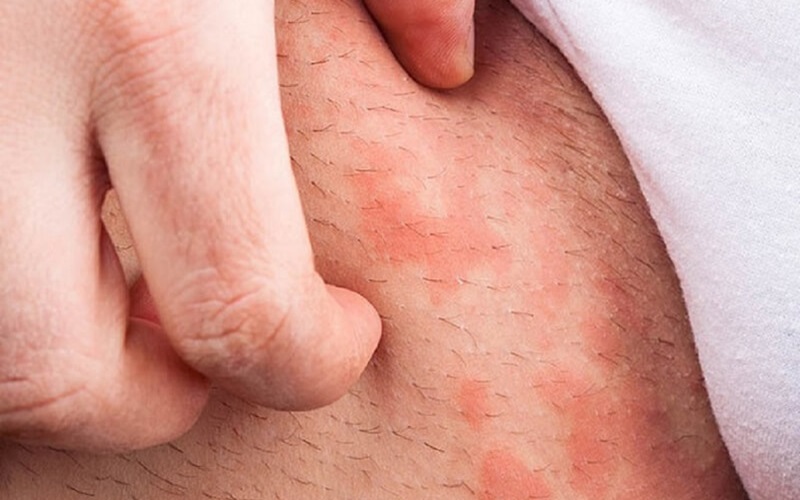 Phát ban vùng bẹn Phát ban vùng bẹn