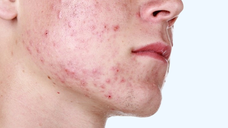 Mụn trứng cá Mụn trứng cá