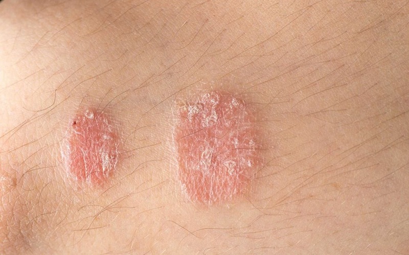 Bệnh vẩy nến Bệnh vẩy nến