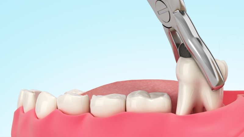 Nhổ răng khôn có ăn thịt bò được không?