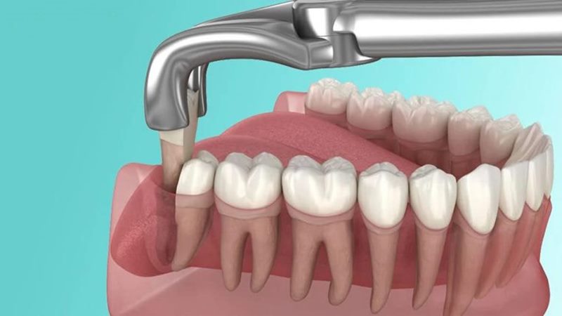  Cách chăm sóc răng sau khi nhổ răng khôn