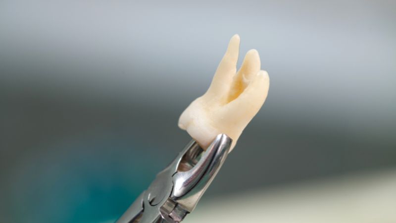 Vì sao cần chú ý vệ sinh răng miệng sau khi nhổ răng khôn?