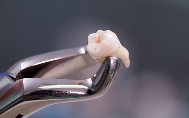 Nhổ răng khôn bị bung chỉ có sao không?