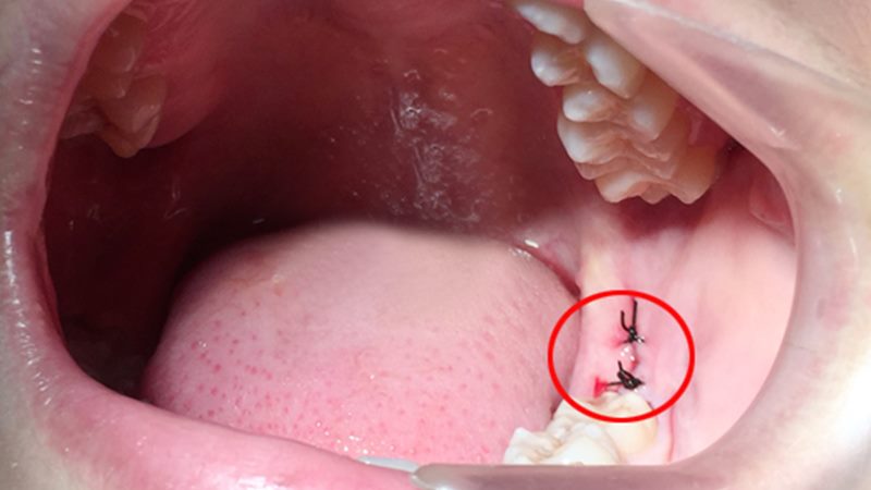 Vì sao sau khi nhổ răng khôn cần khâu vết thương?
