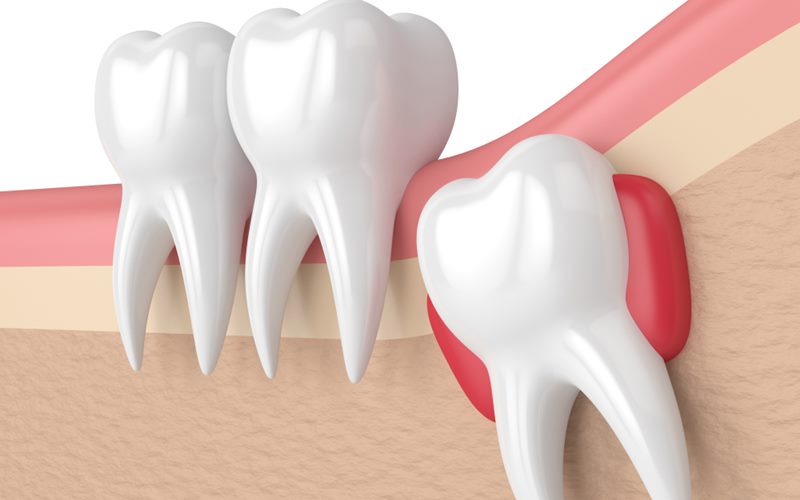 Các loại chỉ để khâu vết thương sau khi nhổ răng khôn