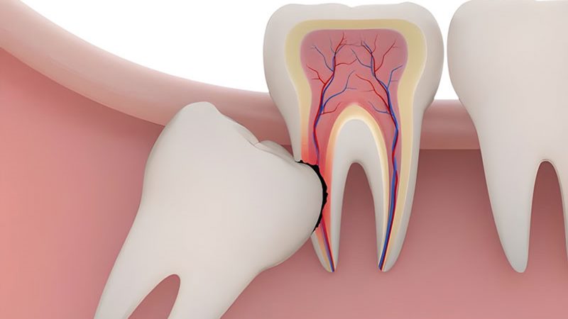 Thời điểm nên cắt chỉ răng khôn
