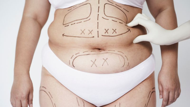 Hút mỡ không nên vượt quá 5-6% trọng lượng cơ thể, tương đương khoảng 4-5 lít