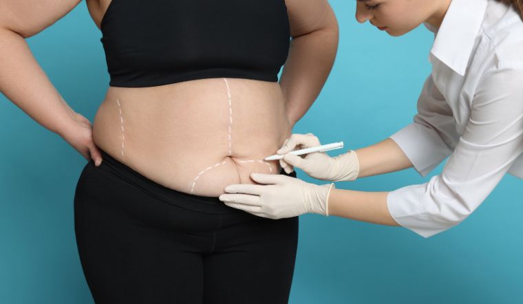 Các biến chứng thường gặp khi hút mỡ giảm béo