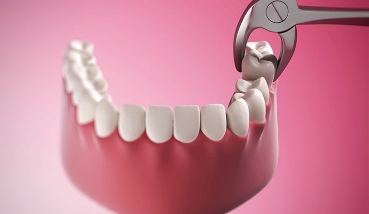 Răng cấm là răng gì? Cách phân biệt răng cấm và răng khôn