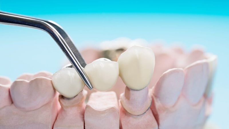 Hướng dẫn cách chăm sóc răng cấm đúng cách