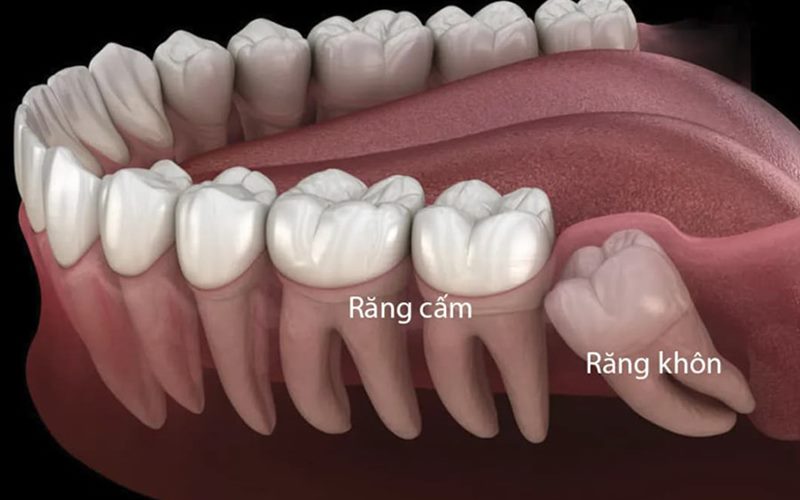 Răng cấm có mấy chân?