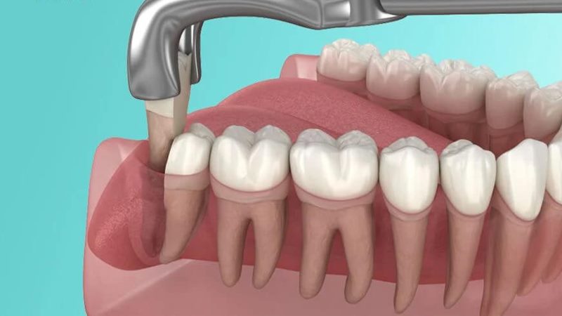 Nhiễm trùng sau khi nhổ răng khôn