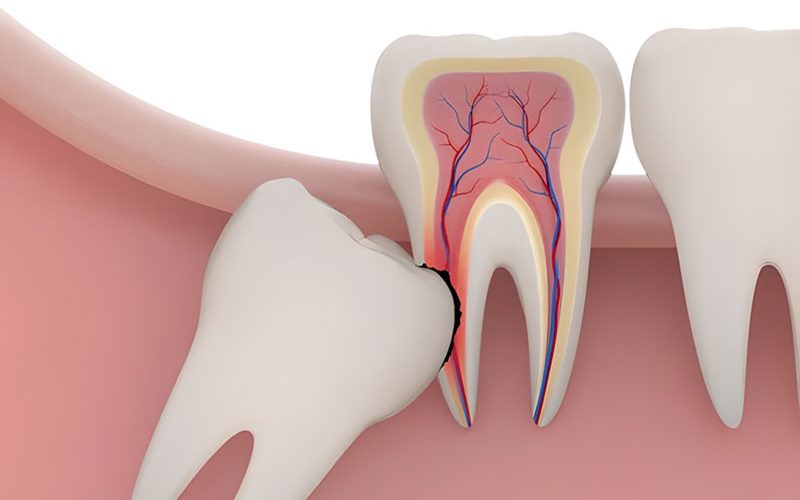 Nguyên nhân vết khâu nhổ răng khôn bị nhiễm trùng