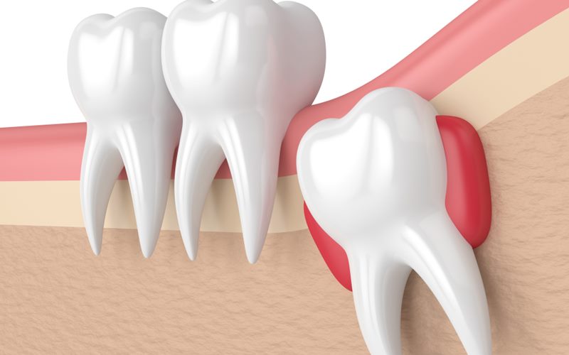 Cách ngăn ngừa nhiễm trùng sau khi nhổ răng khôn
