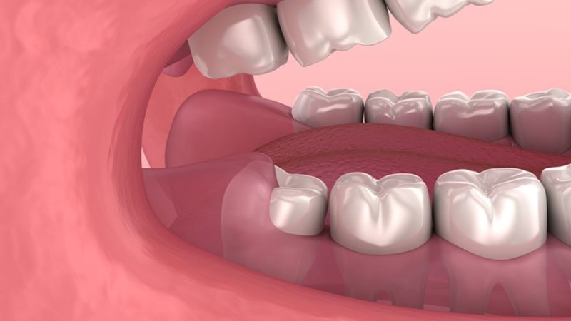 Cách xử lý nhiễm trùng sau khi nhổ răng tại nhà
