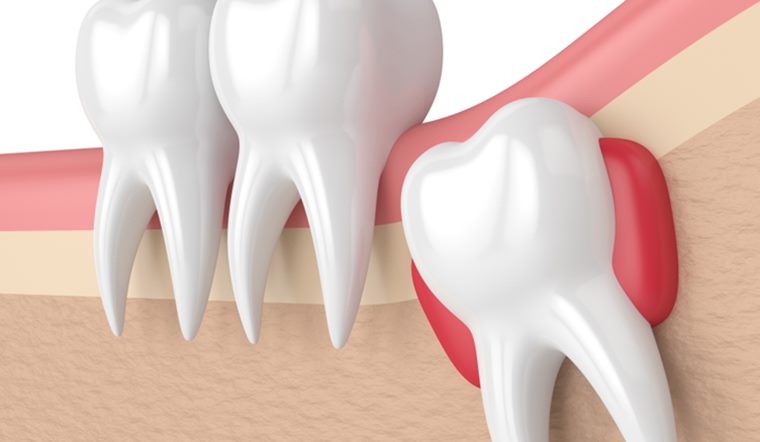 Dấu hiệu nhiễm trùng sau khi nhổ răng khôn cần lưu ý