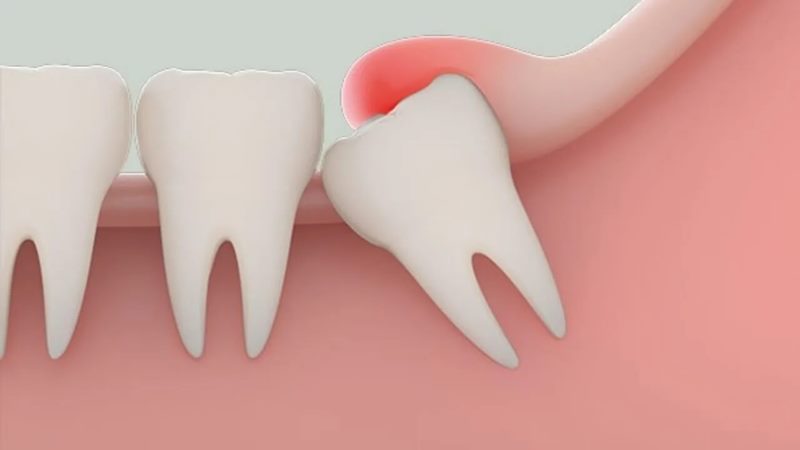 Các dấu hiệu nhiễm trùng sau khi nhổ răng khôn