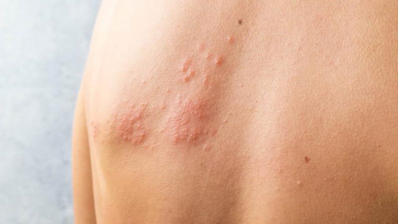 Vì sao người bệnh zona cần hạn chế tiếp xúc với gió trời?