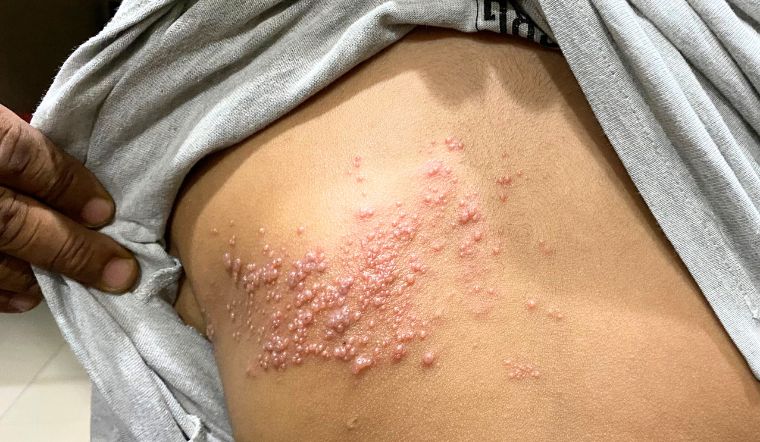 Bị zona thần kinh có cần kiêng gió không? Lưu ý cho người bị zona khi ra gió