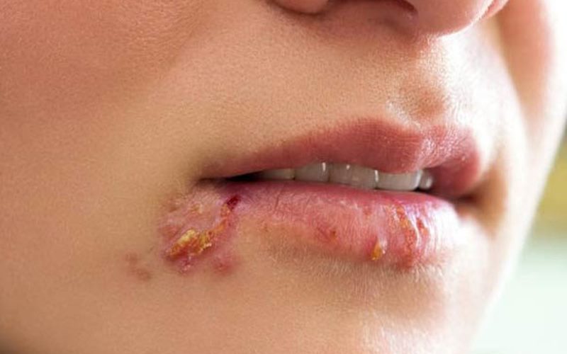 Bị zona thần kinh ăn gì, kiêng gì để không bị sẹo?