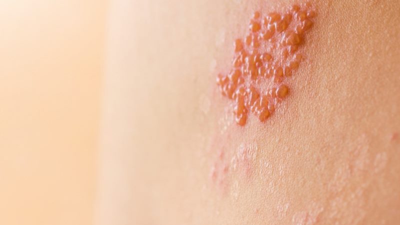 Đặc điểm sẹo do bệnh zona thần kinh