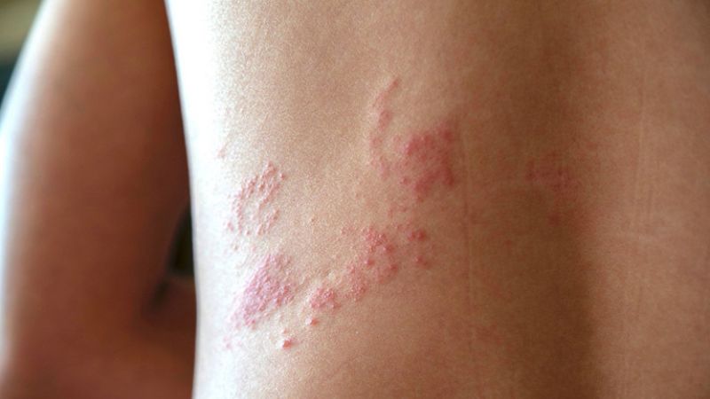 Triệu chứng đau sau zona thần kinh