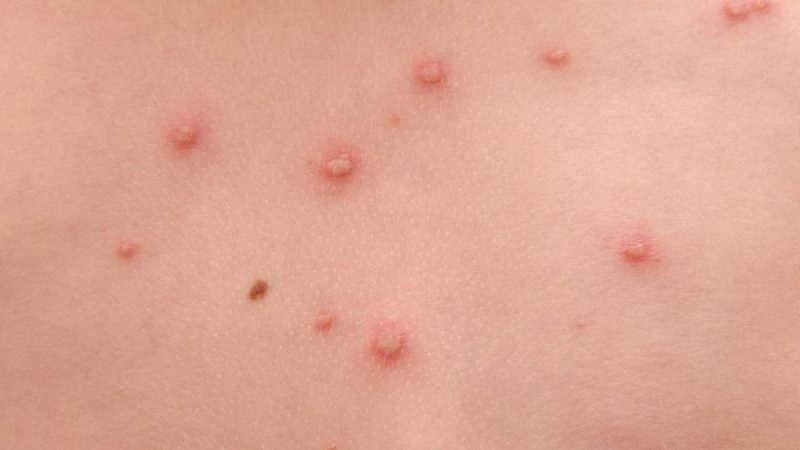 Đối tượng dễ bị đau sau zona thần kinh