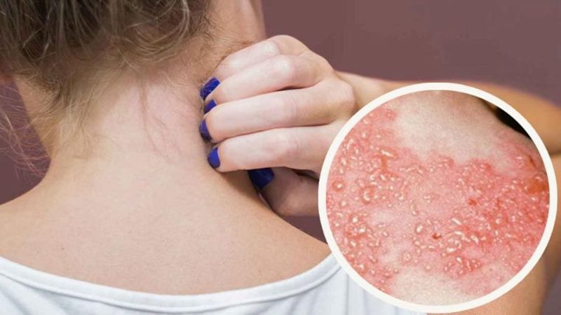 Cách phòng ngừa biến chứng zona thần kinh