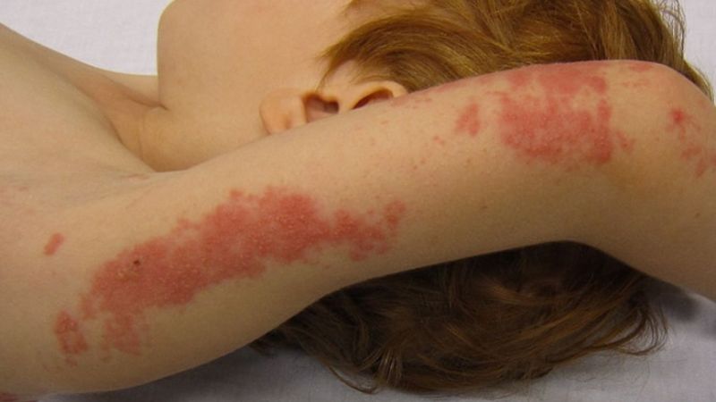 Cách giảm đau sau zona thần kinh