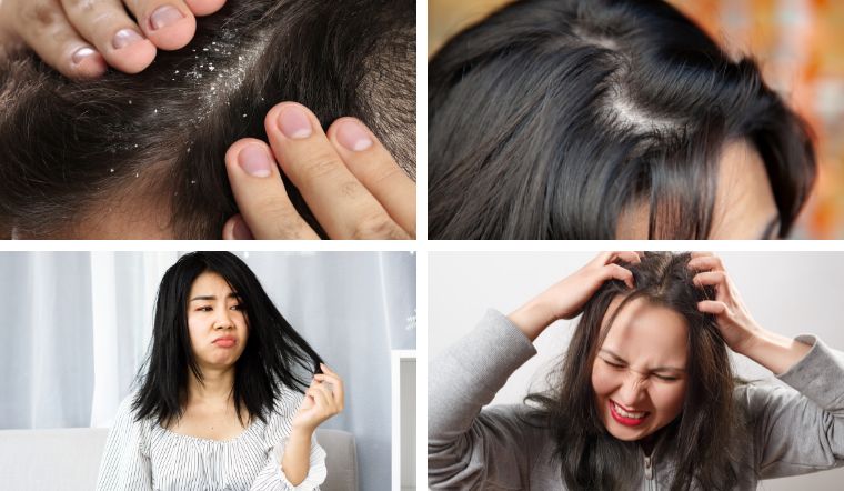 5 dấu hiệu bất ngờ cho thấy bạn đang gội đầu quá ít, khiến tóc gãy rụng