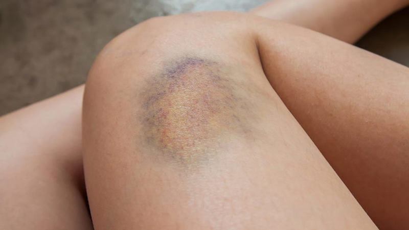 Nguyên nhân gây vết bầm vàng trên da Nguyên nhân gây vết bầm vàng trên da