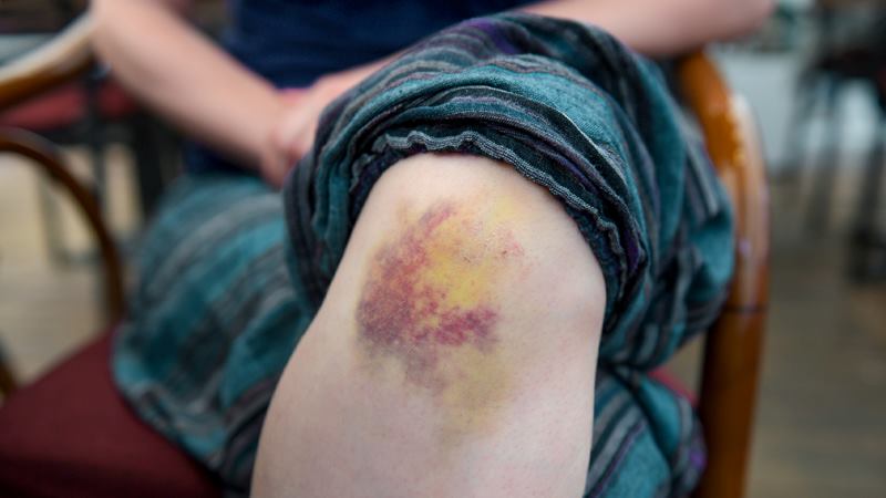 Các biện pháp giúp vết bầm vàng trên da mau hồi phục Các biện pháp giúp vết bầm vàng trên da mau hồi phục