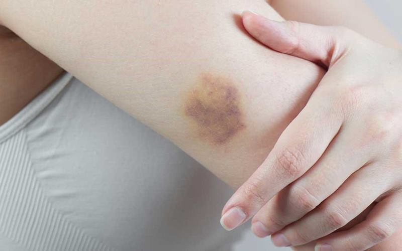 Sự hình thành các vết bầm màu vàng trên da Sự hình thành các vết bầm màu vàng trên da