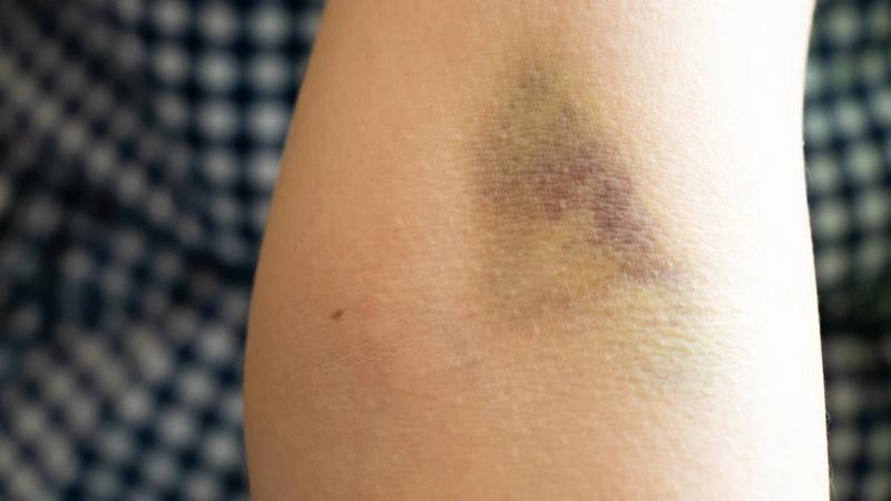 Dấu hiệu nhận biết vết bầm tím sau hiến máu