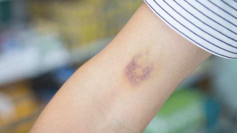 Nguyên nhân và một số yếu tố gây bầm tím sau hiến máu