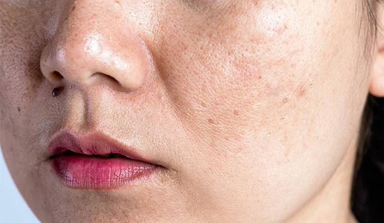 12 cách khắc phục da nhờn hiệu quả tại nhà ai cũng làm được