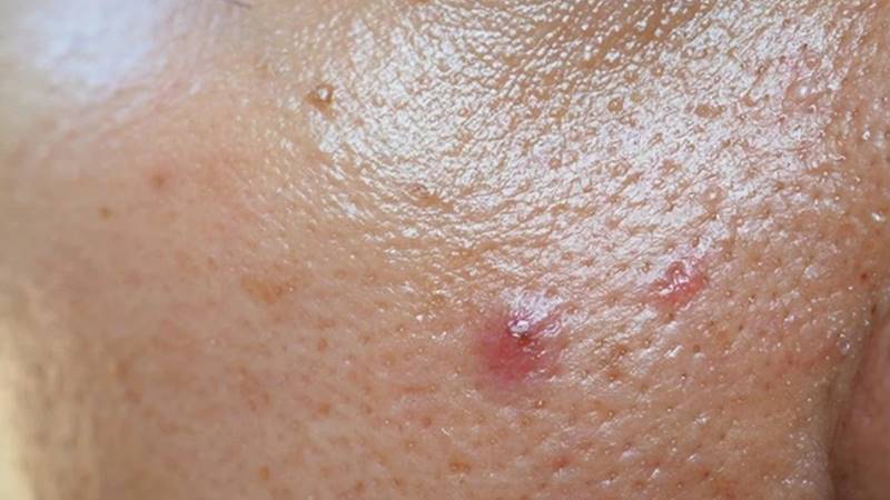 Da nhờn là gì và nguyên nhân gây ra?